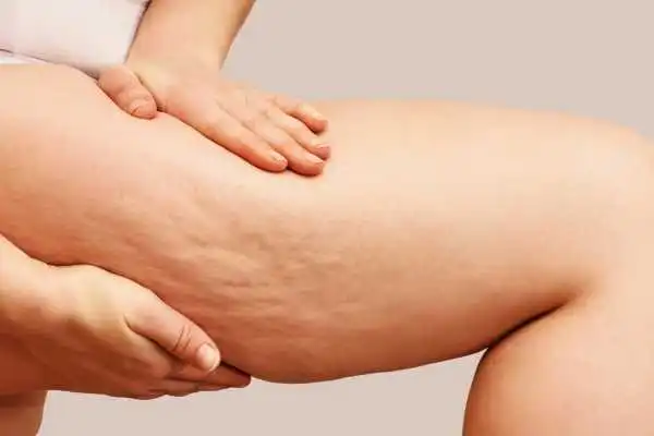 Image of woman showing leg with cellulite Norwich