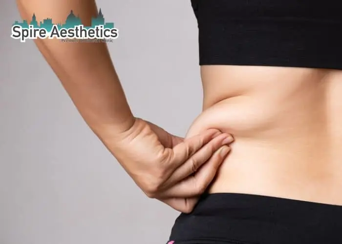 Image of woman pinching fat on their hips Norwich. Fat Freezing treatment