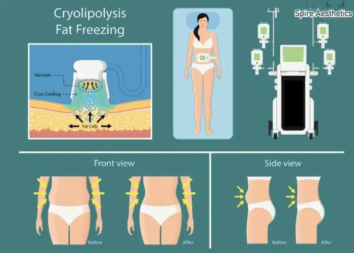 Fat freezing treatment Norwich benefits for competitions to remove stubborn fat deposits.