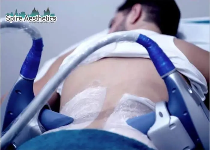Man having fat freezing treatment done on love handles before a competitions Norwich to create a sculpted look.