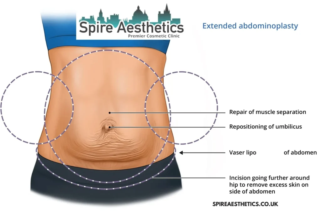 Understanding Loose Skin After Gastric Band Norwich Surgery and HIFU Treatment