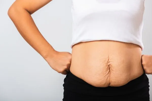 Image of a woman's stomach after weight loss with sagging skin following a gastric band Norwich
