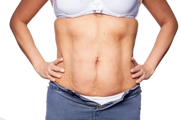 sagging skin on woman's stomach after weight loss injections Norwich