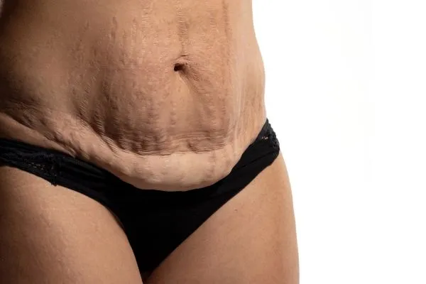 Image of womans stomach after weight loss injections Norwich showing saggy skin