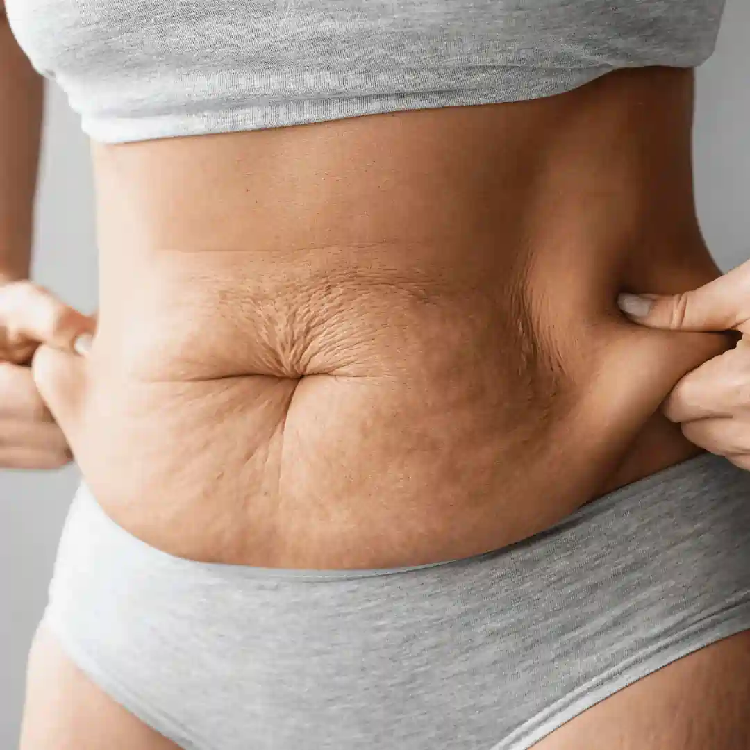 Is It Normal to Have Loose Skin After Pregnancy Norwich?